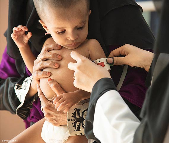 80% dzieci w Jemenie wymaga pomocy humanitarnej. Najmodsi umieraj z godu UNICEF Polska apeluje o pomoc